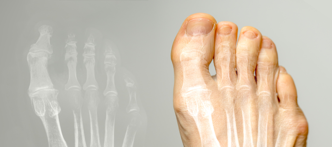 Hallux Rigidus